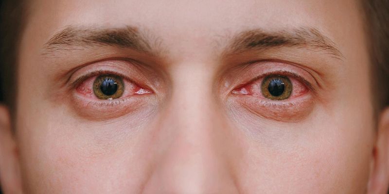 Does CBD Make Your Eyes Red? Find Out